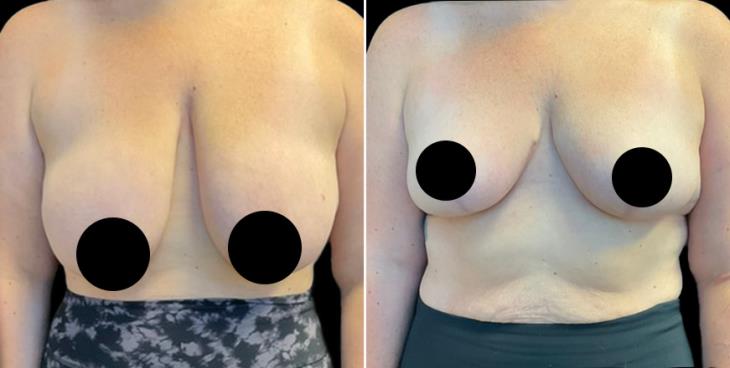 Breast Lift